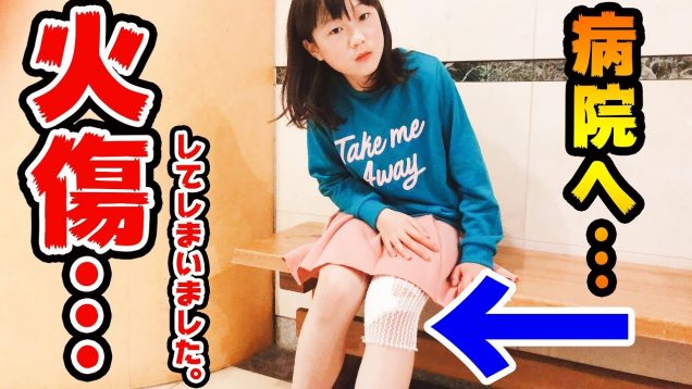 火傷してしまいました。。。 病院へ。。。【しほりみチャンネル】