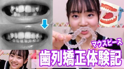 【歯列矯正体験談】痛み、悩み、良いこと、お金のこと、全部話します。【インビザライン】【マウスピース矯正】【ANN & RYO 】